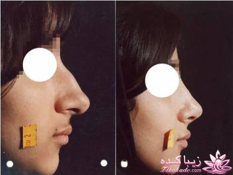 جراحی بینی - جراحی زیبایی