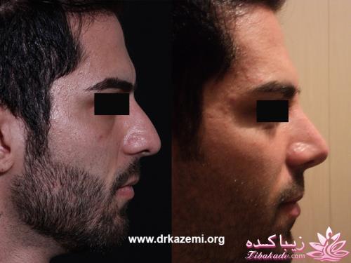 جراحی بینی - جراحی زیبایی