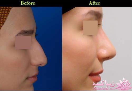 جراحی بینی - جراحی زیبایی