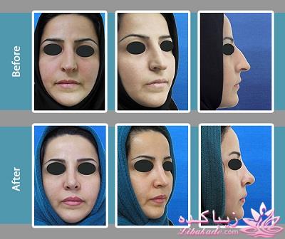 جراحی بینی - جراحی زیبایی