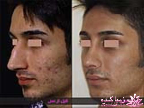 جراحی بینی - جراحی زیبایی