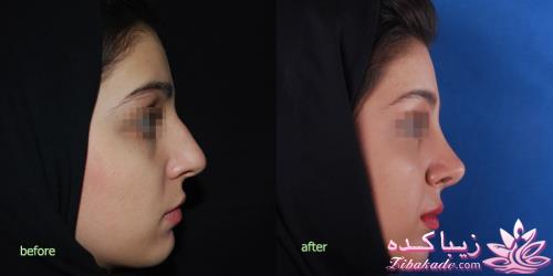 جراحی بینی - جراحی زیبایی