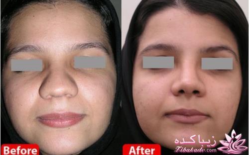 جراحی بینی - جراحی زیبایی