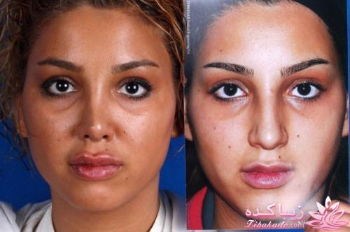 جراحی بینی - جراحی زیبایی