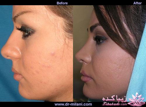 جراحی بینی - جراحی زیبایی