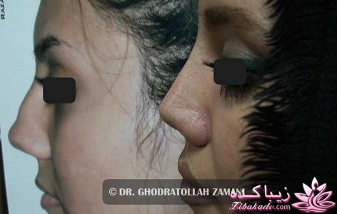 جراحی بینی - جراحی زیبایی