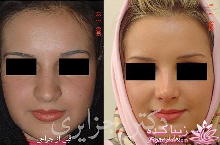 جراحی بینی - جراحی زیبایی
