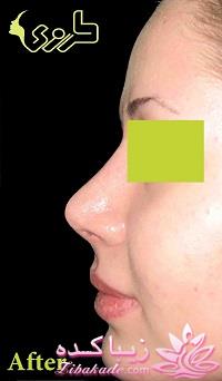 جراحی بینی - جراحی زیبایی