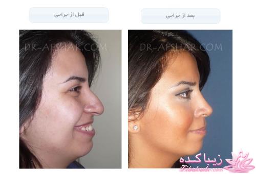 جراحی بینی - جراحی زیبایی