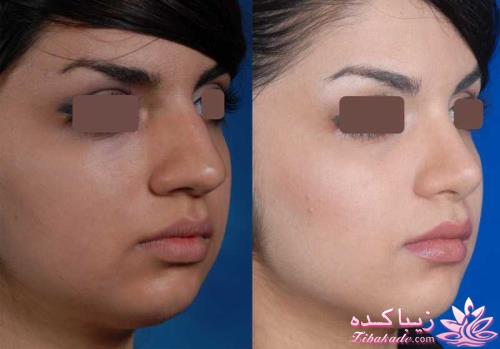 جراحی بینی - جراحی زیبایی