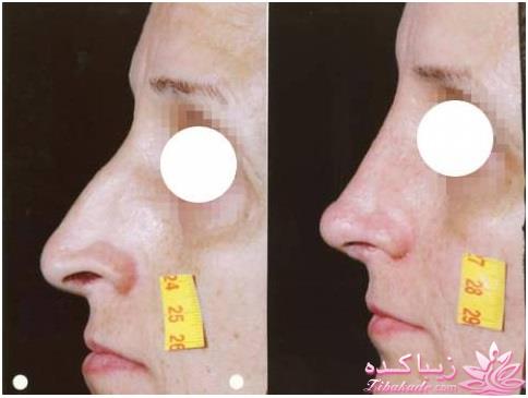 جراحی بینی - جراحی زیبایی