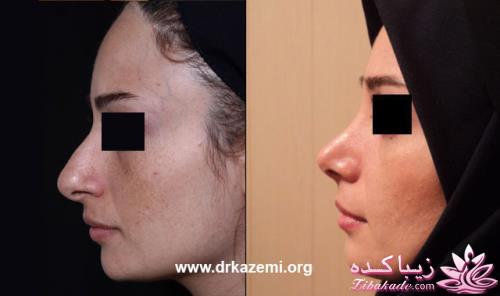 جراحی بینی - جراحی زیبایی