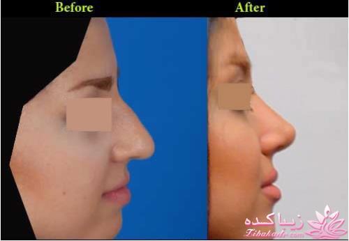جراحی بینی - جراحی زیبایی