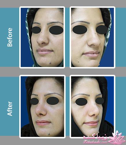 جراحی بینی - جراحی زیبایی