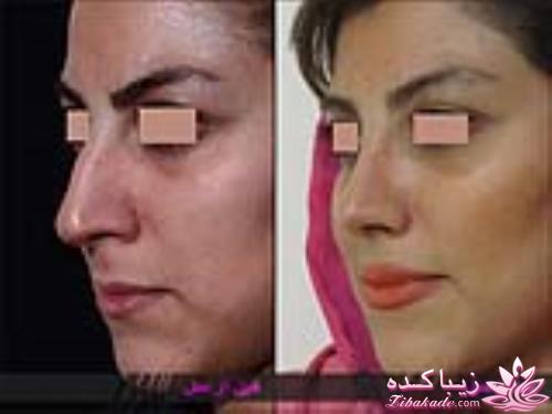 جراحی بینی - جراحی زیبایی