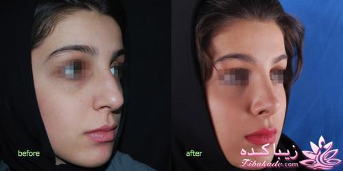 جراحی بینی - جراحی زیبایی