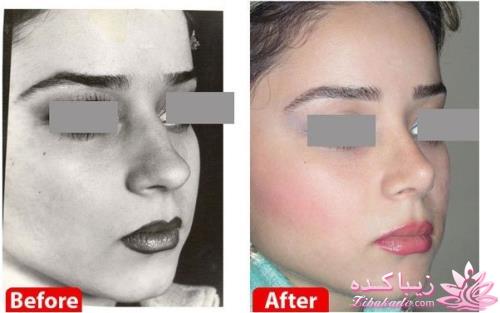 جراحی بینی - جراحی زیبایی