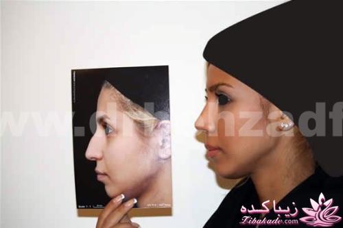 جراحی بینی - جراحی زیبایی