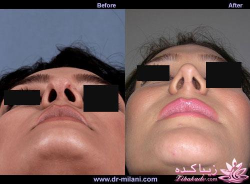 جراحی بینی - جراحی زیبایی