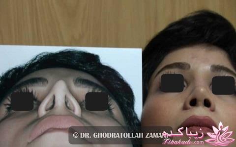 جراحی بینی - جراحی زیبایی