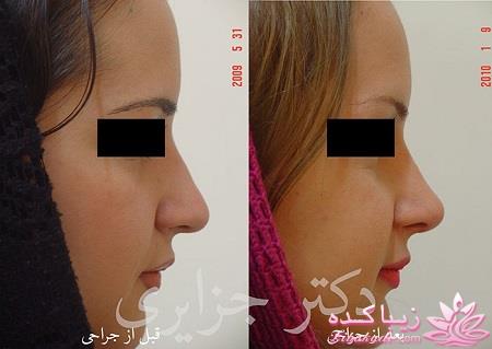 جراحی بینی - جراحی زیبایی