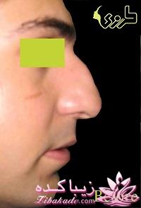 جراحی بینی - جراحی زیبایی