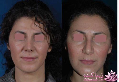 جراحی بینی - جراحی زیبایی