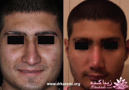 جراحی بینی - جراحی زیبایی