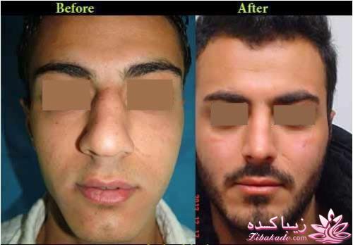 جراحی بینی - جراحی زیبایی