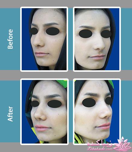 جراحی بینی - جراحی زیبایی