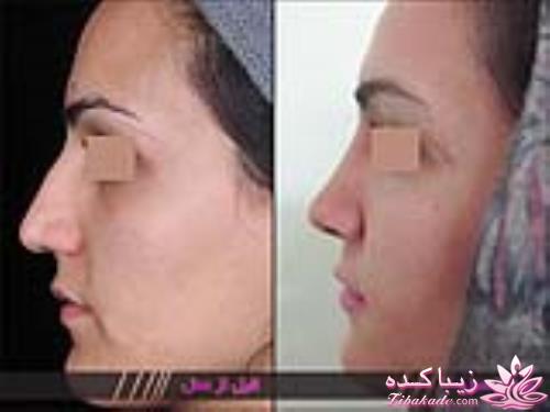 جراحی بینی - جراحی زیبایی