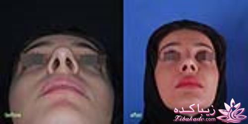 جراحی بینی - جراحی زیبایی