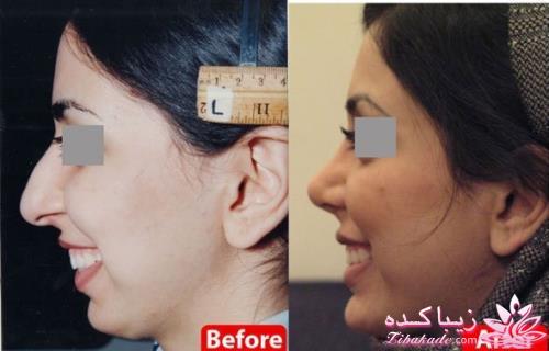 جراحی بینی - جراحی زیبایی