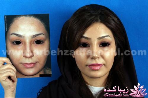 جراحی بینی - جراحی زیبایی