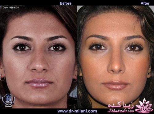 جراحی بینی - جراحی زیبایی