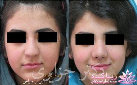 جراحی بینی - جراحی زیبایی