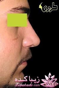 جراحی بینی - جراحی زیبایی