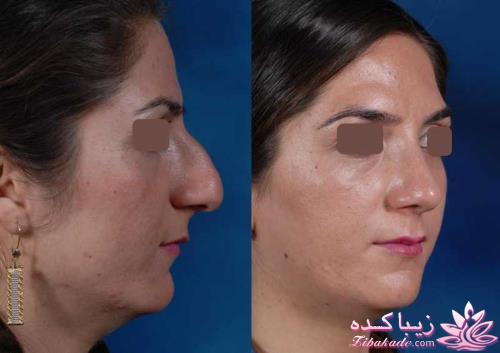 جراحی بینی - جراحی زیبایی