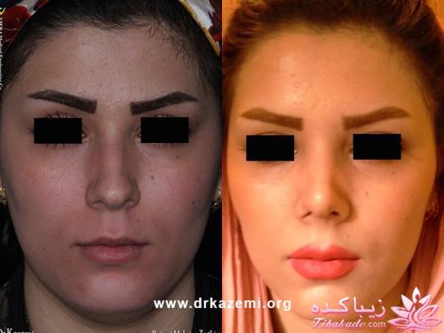 جراحی بینی - جراحی زیبایی