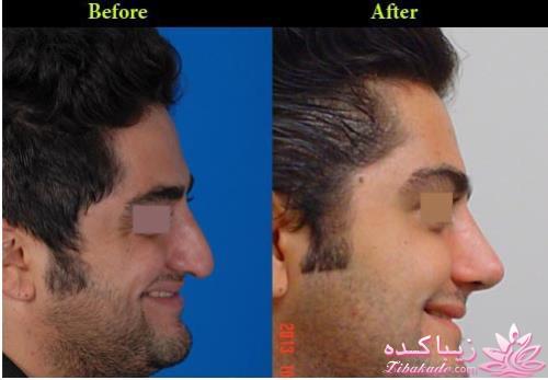 جراحی بینی - جراحی زیبایی