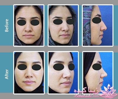 جراحی بینی - جراحی زیبایی