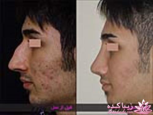 جراحی بینی - جراحی زیبایی
