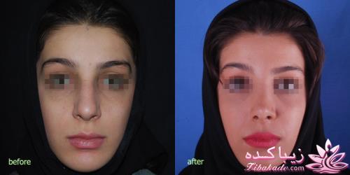 جراحی بینی - جراحی زیبایی