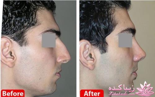 جراحی بینی - جراحی زیبایی