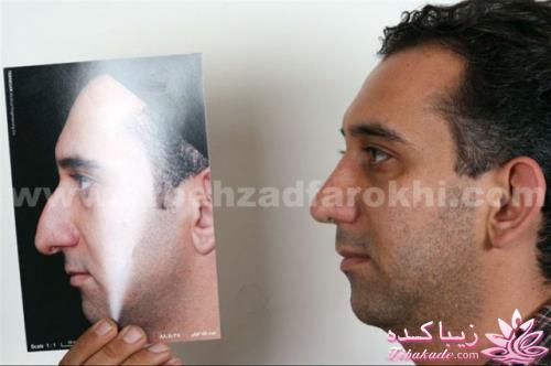 جراحی بینی - جراحی زیبایی