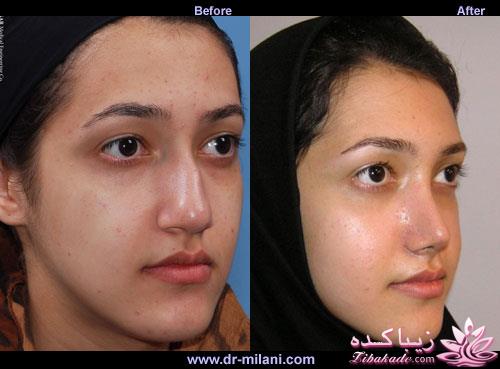 جراحی بینی - جراحی زیبایی