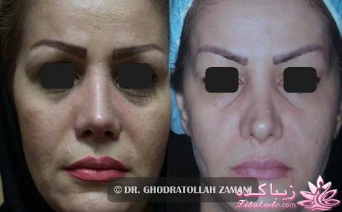 جراحی بینی - جراحی زیبایی