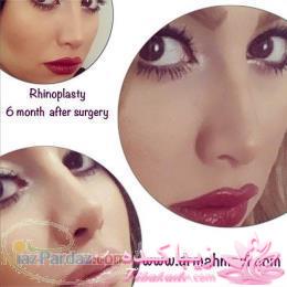 جراحی بینی - جراحی زیبایی