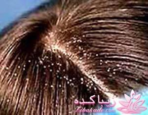 شوره سر ، علل و درمان