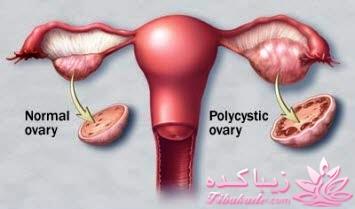 به سندرم تخمدان پلی کیستیک مبتلا هستید؟